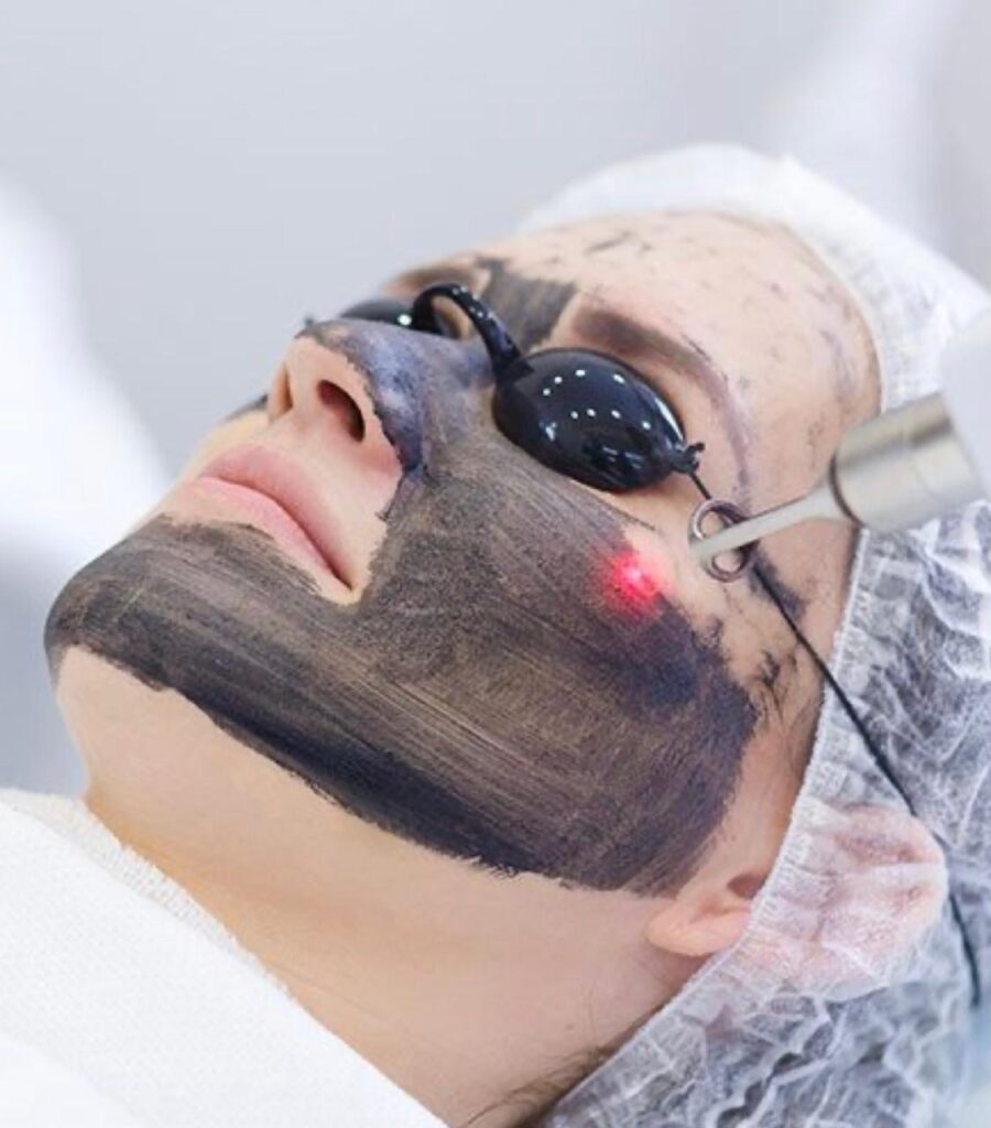 Perawatan laser wajah dengan masker karbon dan kacamata pelindung