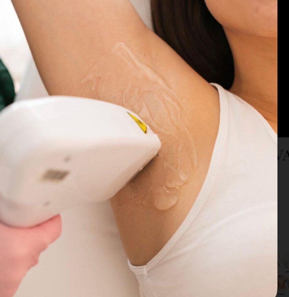 Laser hair removal pada area ketiak