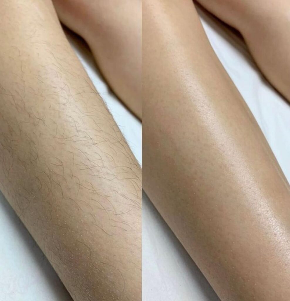 Perbandingan kaki sebelum dan sesudah waxing