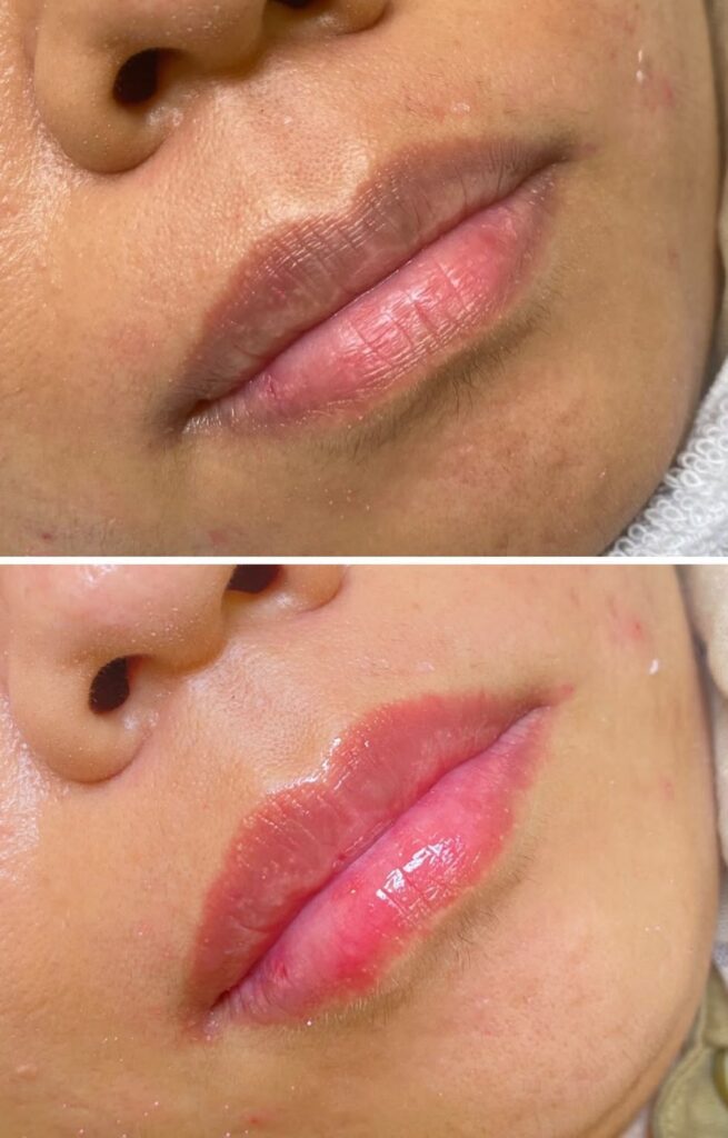 Bibir yang gelap sebelum perawatan (atas) dan bibir yang lebih cerah setelah Laser Bibir (bawah)