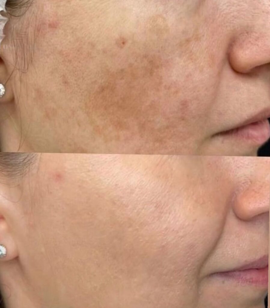 Pipi dengan flek sebelum perawatan (atas) dan sesudah 3 sesi Laser Pico (bawah)