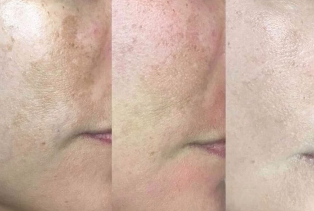 Tiga foto pipi yang sama, flek makin pudar dari kiri ke kanan selama 3 sesi Laser Pico