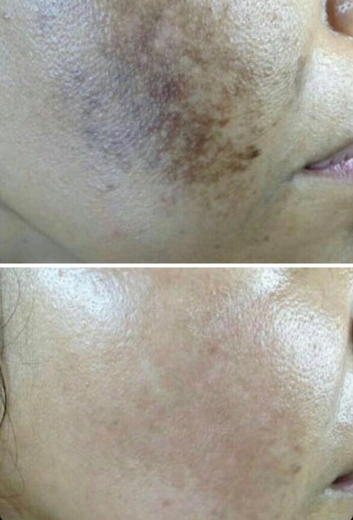 Pipi dengan flek gelap sebelum perawatan (atas) dan sesudah 3 sesi Laser Pico (bawah)